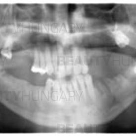 dental implant Budapest-Batorfi D