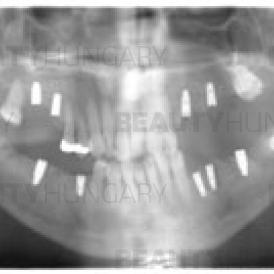 dental implantation, 4 upper and 5 lower implants-Batorfi Clinic