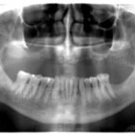 dental implantation Hungary