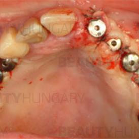 dental implantation Budapest