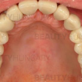 dental implant Hungary