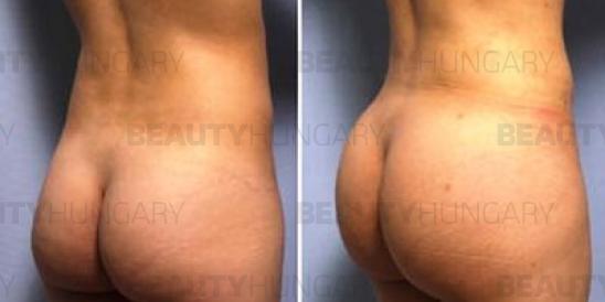 Brazilian butt lift surgery abroad