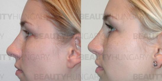 nose reshaping surgery