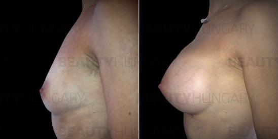 breast implant surgery Budapest
