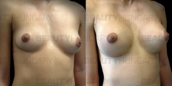 cheap breast enlargement