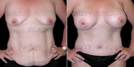 breast and body restoration 