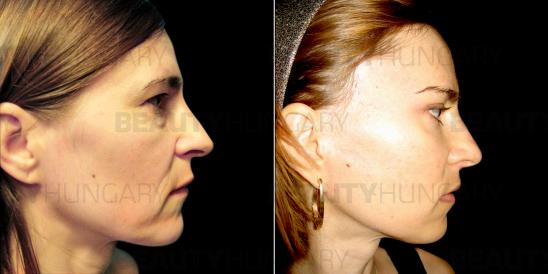 woman mid face lift 
