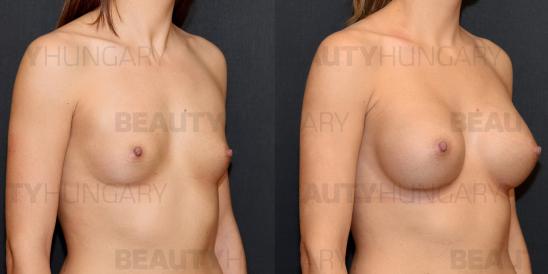 breast augmentation implant