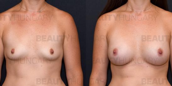breast enlargement surgery with implant 