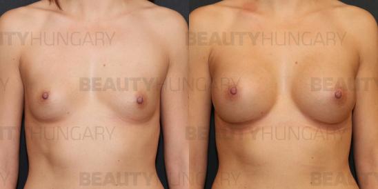 breast enlargement 