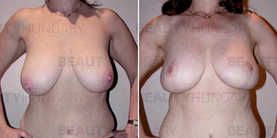 breast reduction 