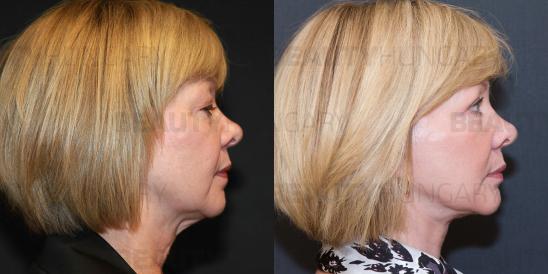 full face and neck lift with upper and lower eyelid surgery